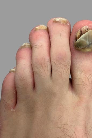 disgusting fungus infested fot with sickly yellow toenails